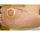 Diabetic Foot Ulcer